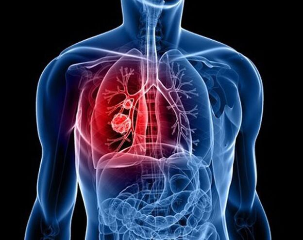 Parassiti nei polmoni